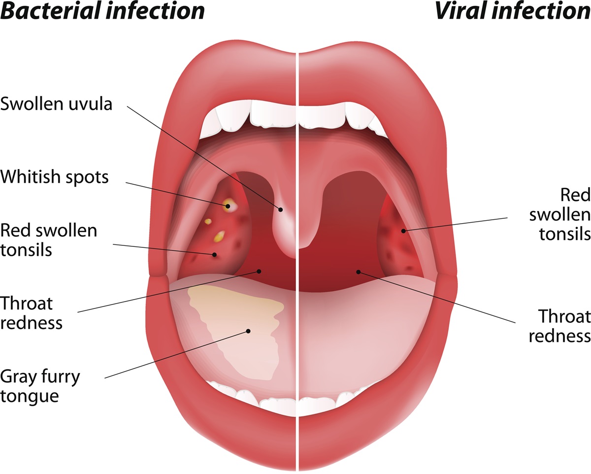 Vírus a Baktéria v hrdle - rozdiely